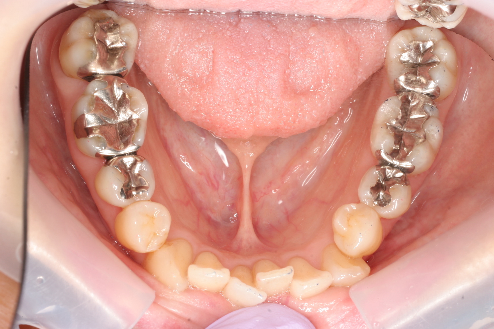 術前の下の前歯